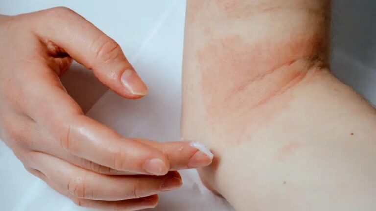 Psoriasis-vennlig hudpleierutine