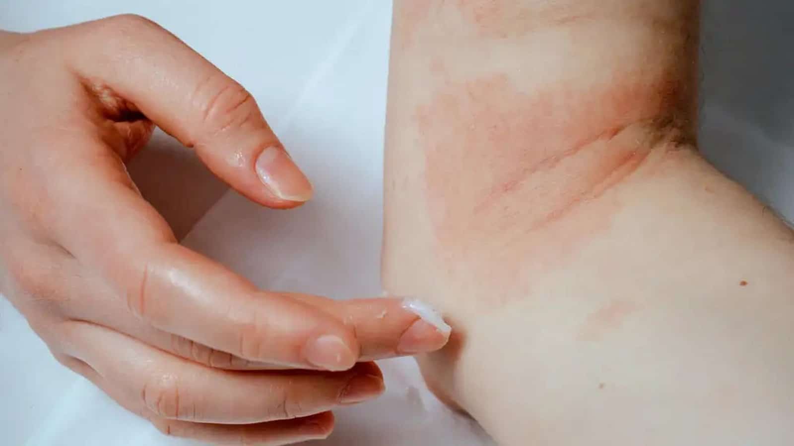 Psoriasis-vennlig hudpleierutine