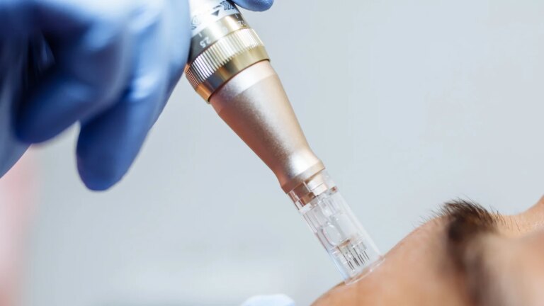 Anmeldelse: Jeg prøvde microneedling – dette er mine takeaways
    

