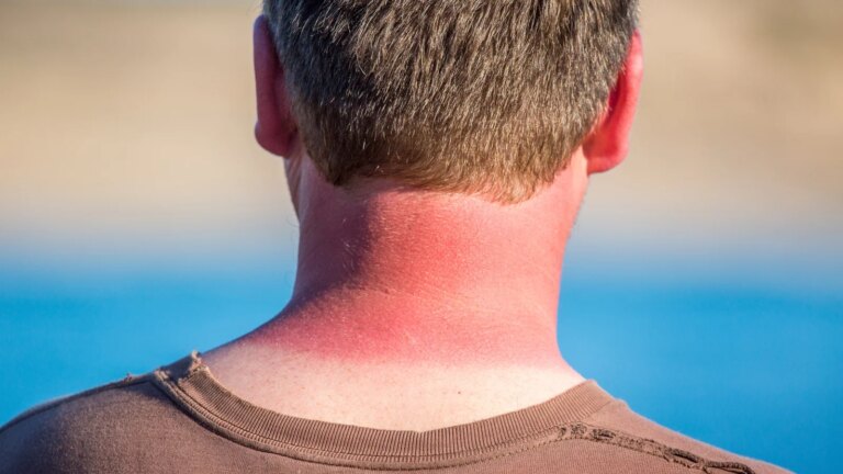 5 mÃ¥ter Ã¥ lindre sÃ¥r hud hvis du ble brent i solen
    

