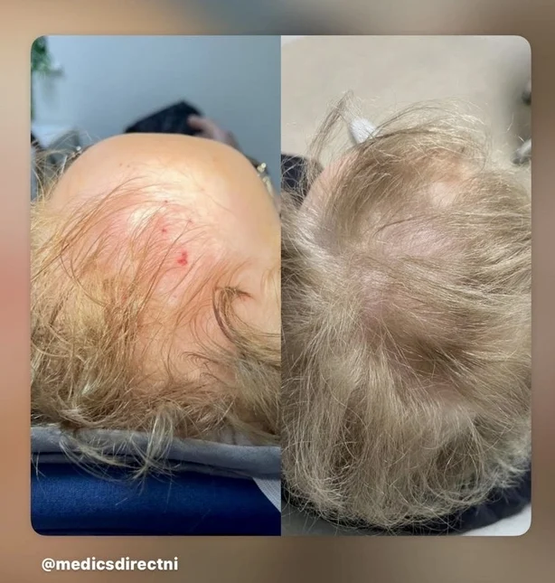 Bilder før og etter hårtap